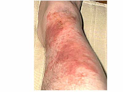 poison ivy rashes. poison ivy rash pictures.