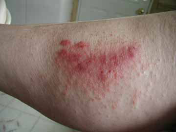 What is poison oak rash?