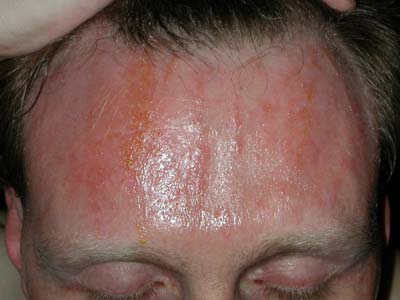 allergic reaction rash. Craig Clayton Rash
