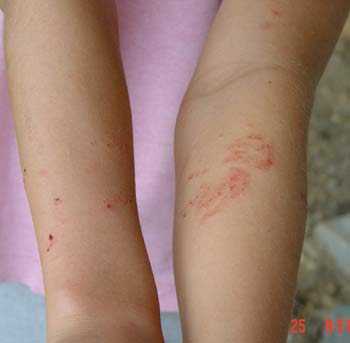 systemic poison ivy pictures. contact with poison ivy,