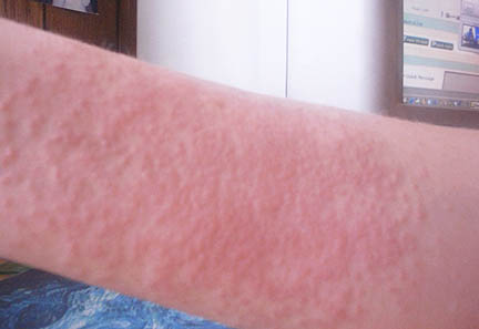 poison ivy rash pics. I got this rash and it#39;s on my