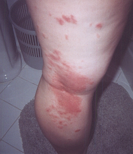mild poison ivy rashes. these pics are of a Rash that