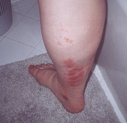 a brown recluse spider bite, and Vasculitis?? go Figure, it looks like