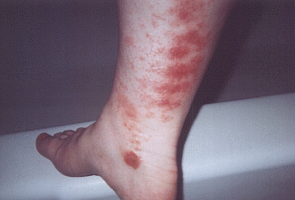 a brown recluse spider bite, and Vasculitis?? go Figure, it looks like